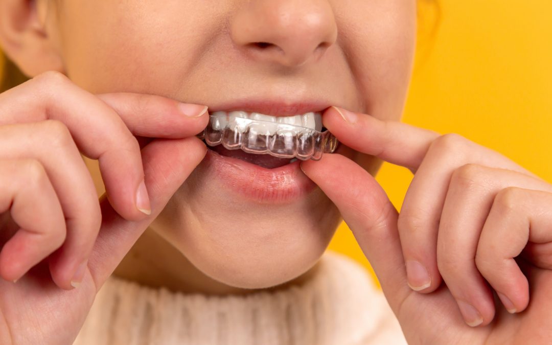 Invisalign Braces Price