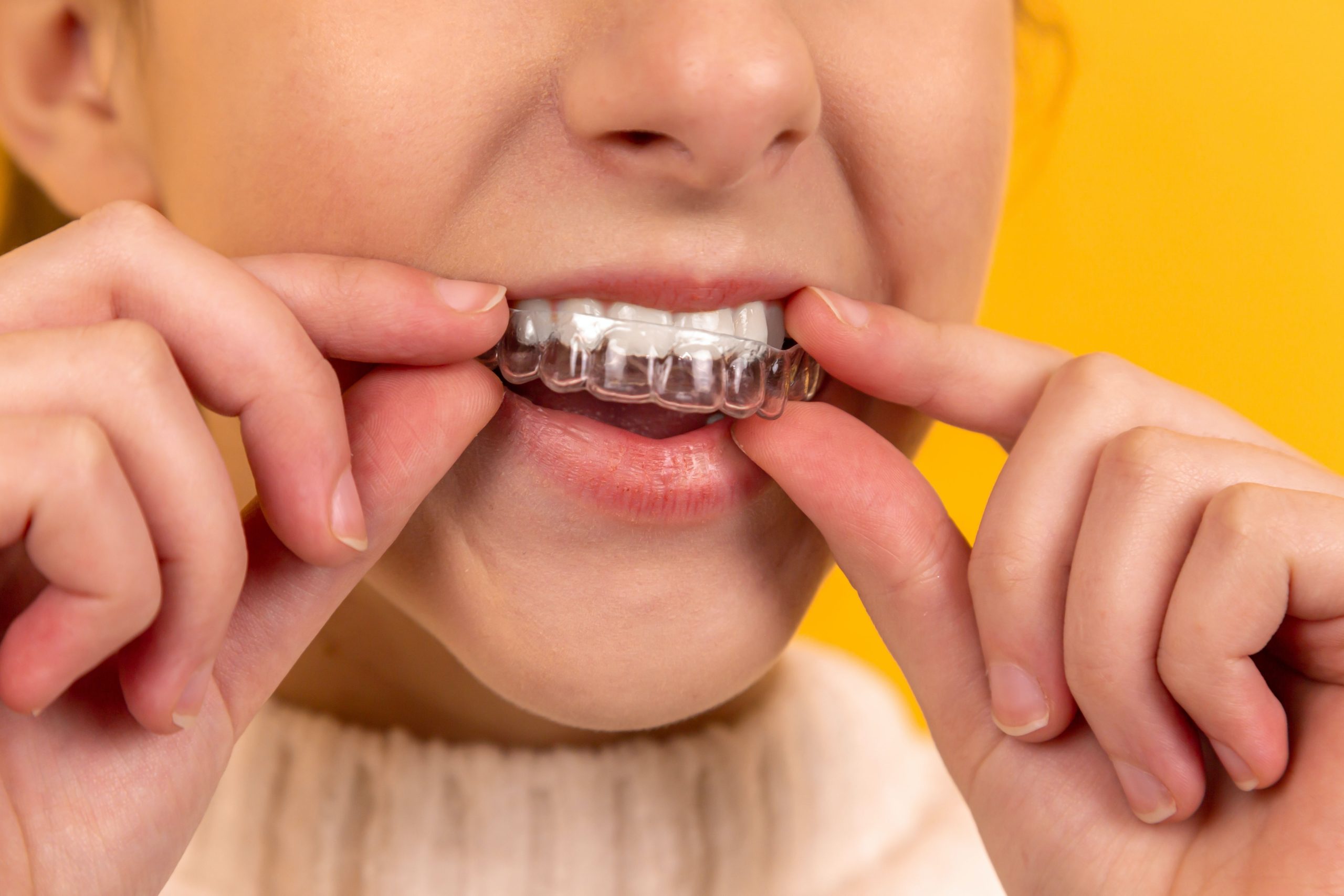 Invisalign Braces Price