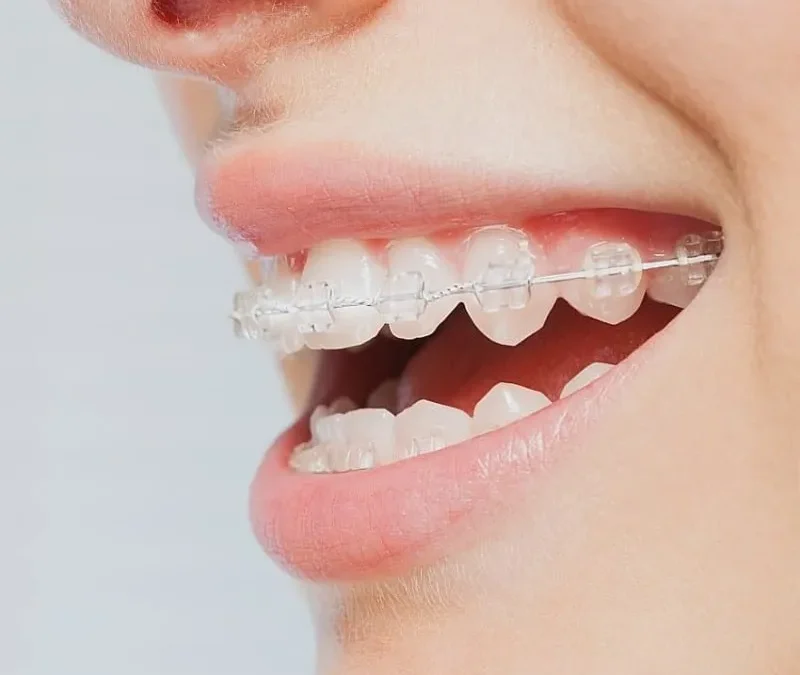 Your Go-To Experts for Affordable, Quality Braces