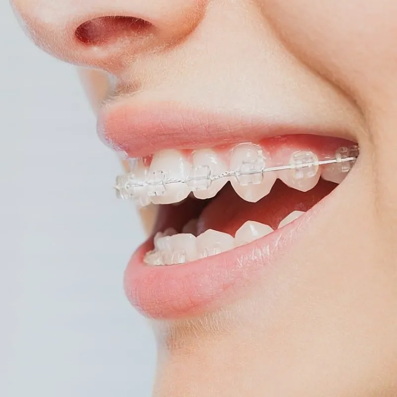 qst-clear-braces-close-up-side-on-800x800 PD_cant-wait